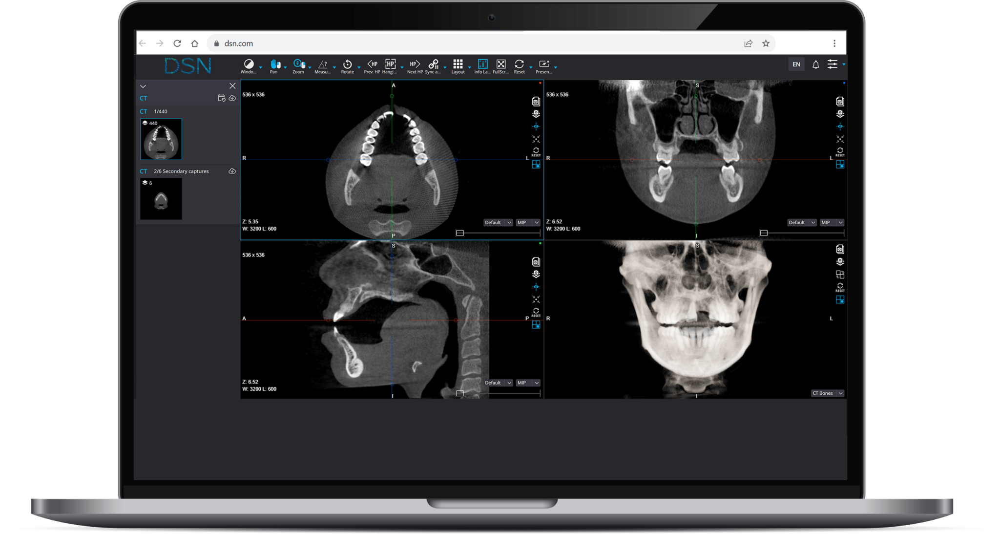 Laptop displaying DSN Imaging software UI, showcasing dental imaging tools, patient data, and intuitive interface design.